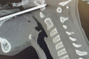 Xray